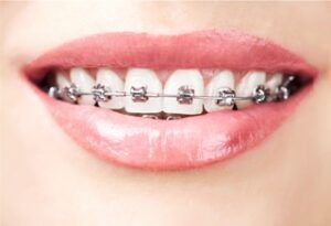 Braces